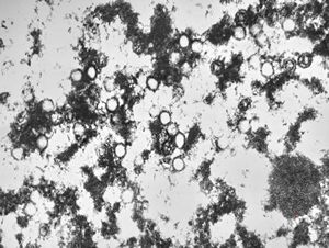 F,8y. | varicella pneumonia F,8y. | varicella pneumonia